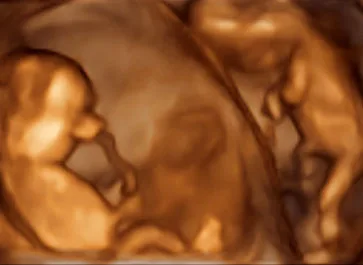 3D-Ultraschall einer Zwillingsschwangerschaft.