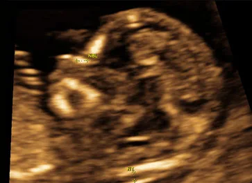 Ultraschallbild: Nasenbeindarstellung, 12.–14. SSW.